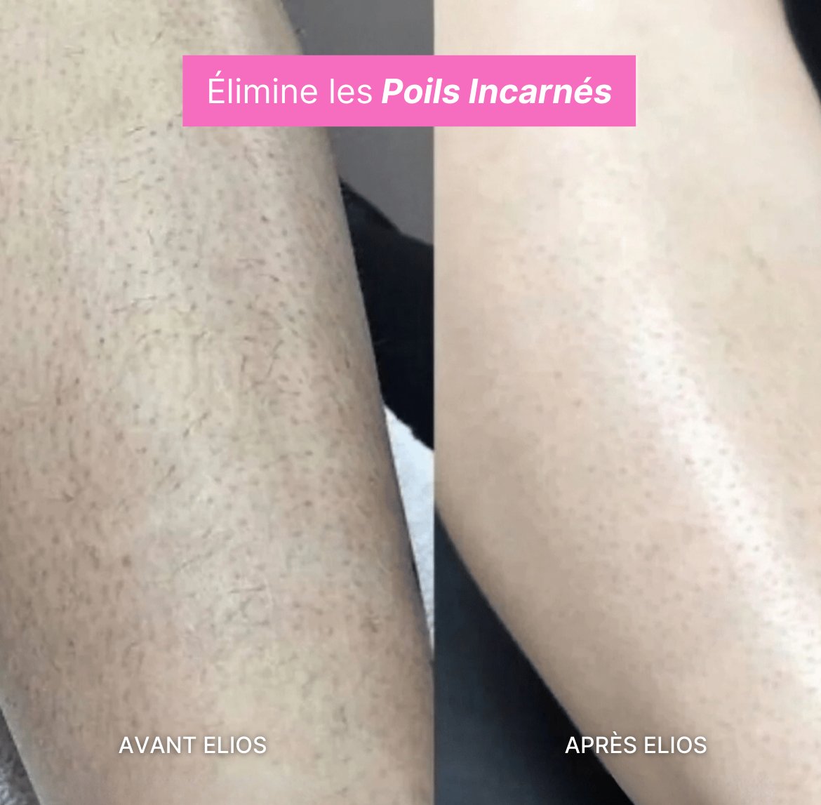 Rasoir ELIOS® + Gant Exfoliant Offert