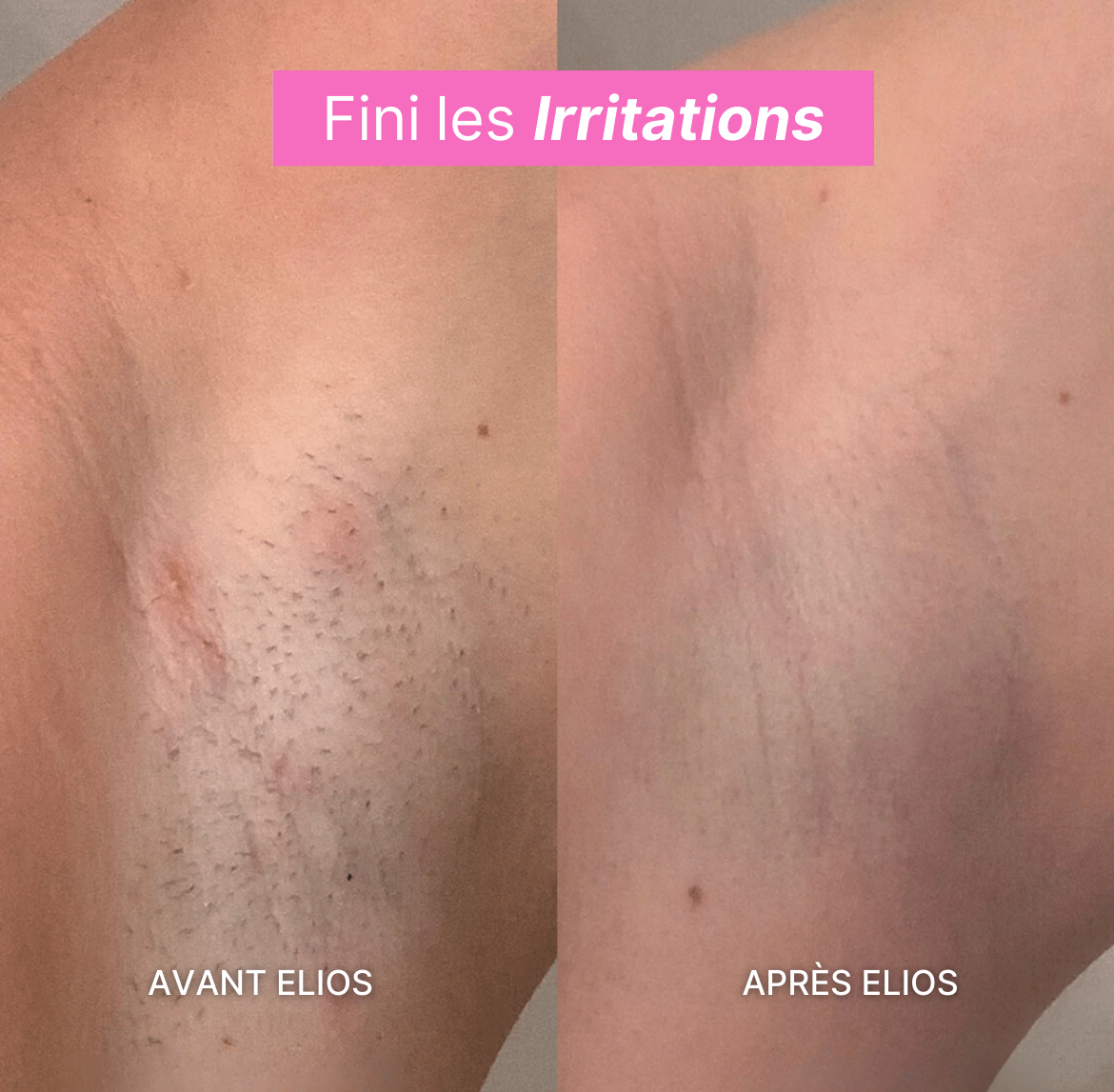 Rasoir ELIOS® + Gant Exfoliant Offert