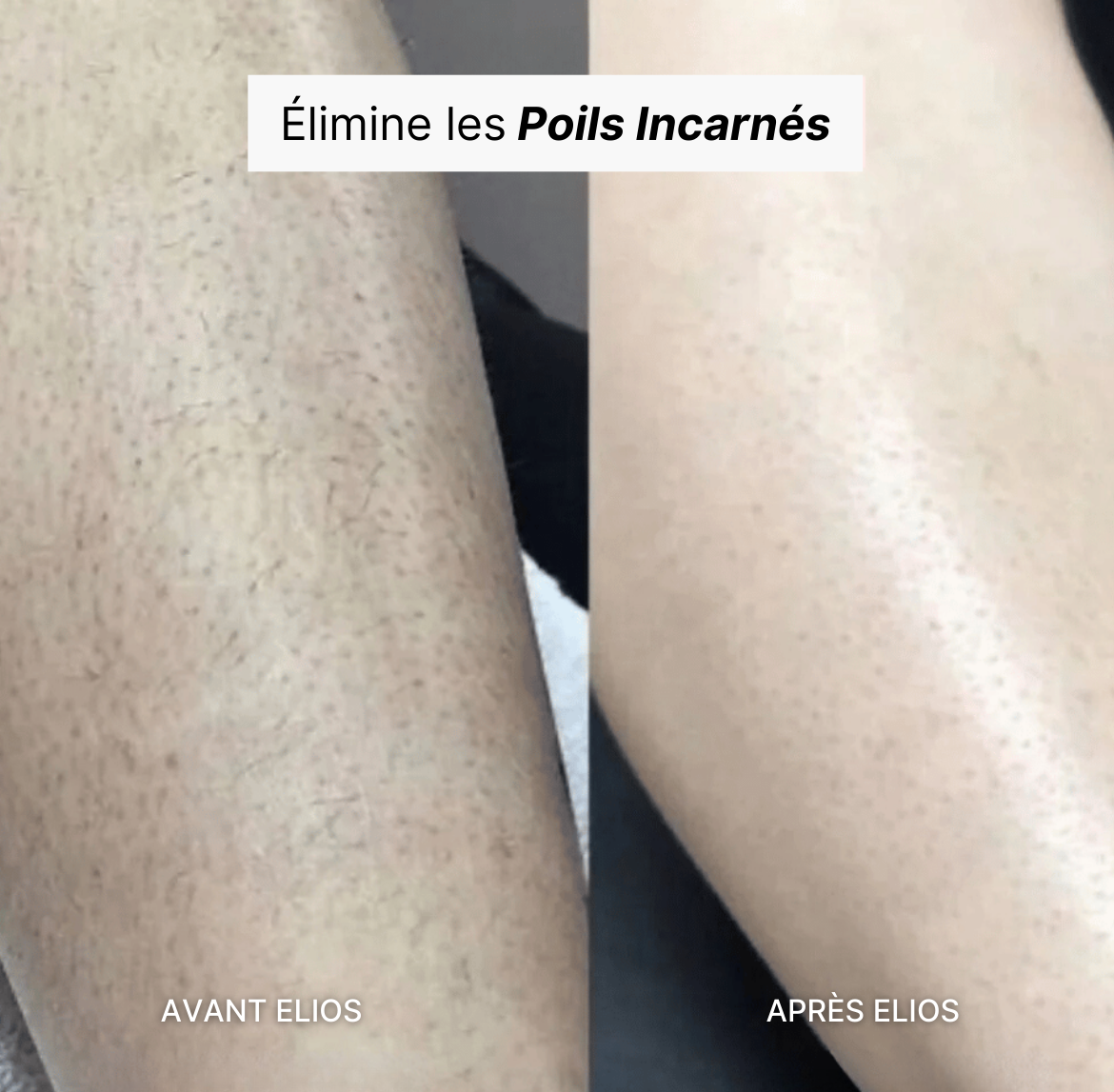 Rasoir ELIOS® + Gant Exfoliant Offert