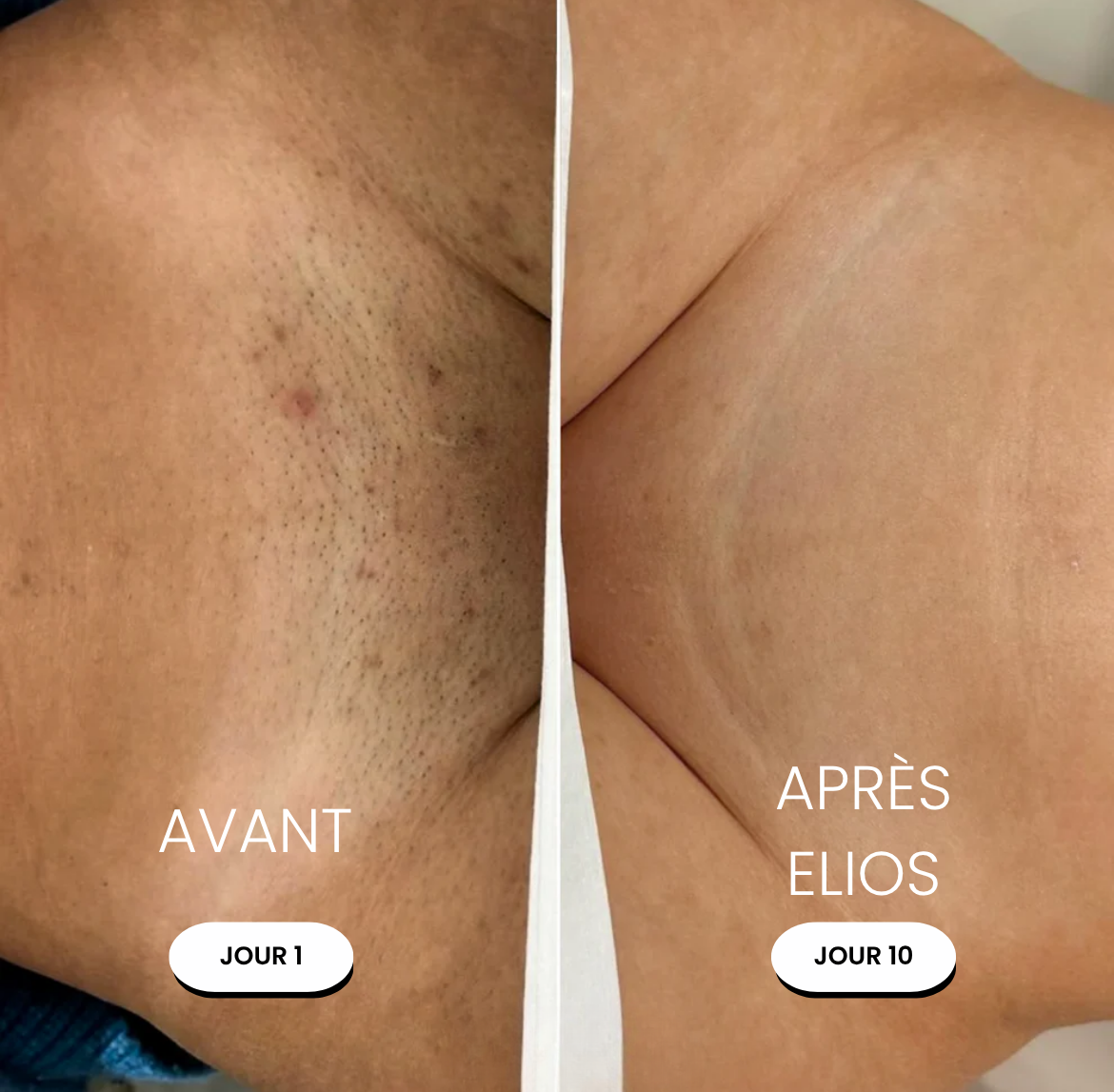 Rasoir ELIOS® - Elios